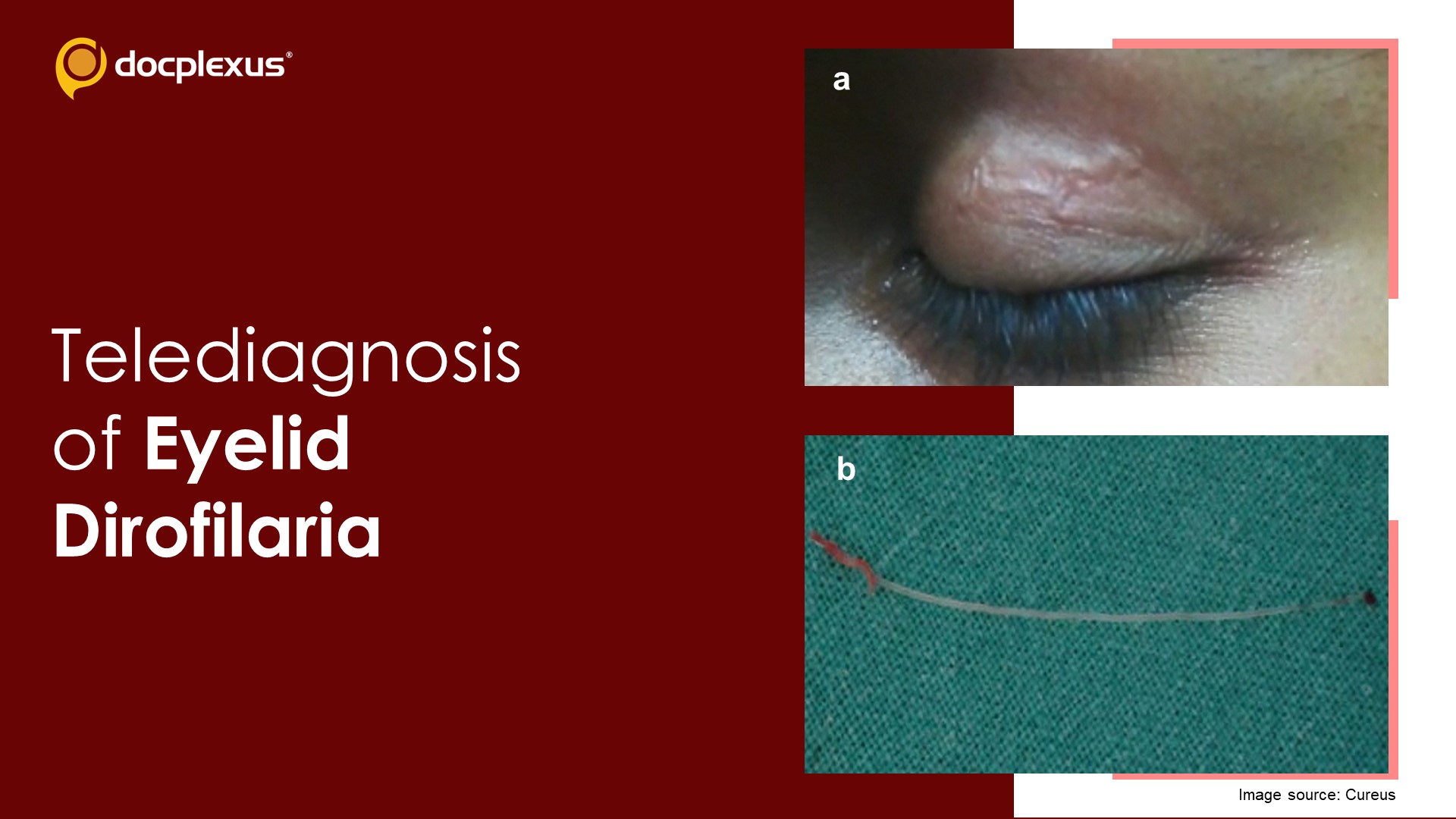 Diagnosis of Subcutaneous Ocular Dirofilariasis via Teleconsultation