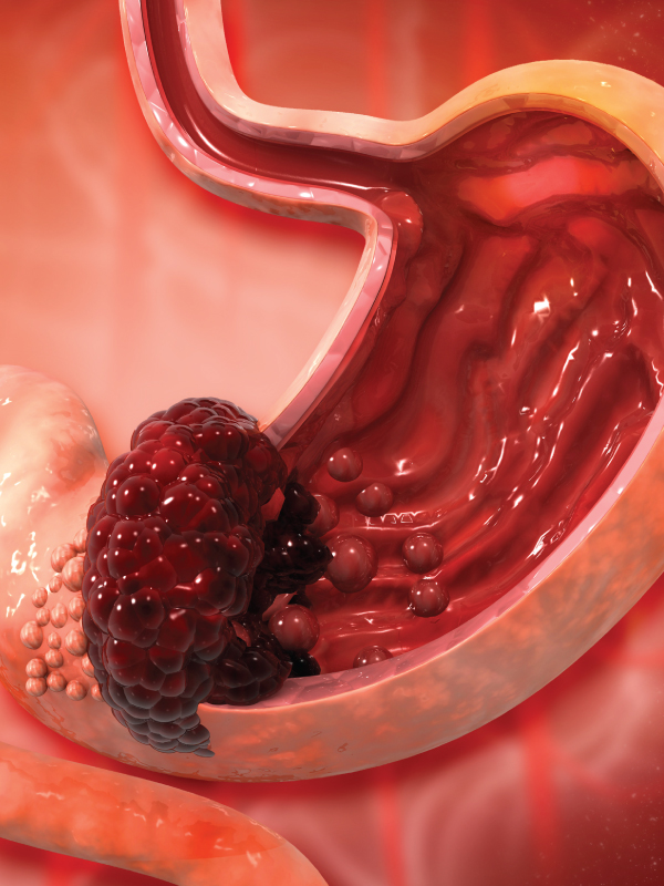 Management of Carcinoma Stomach