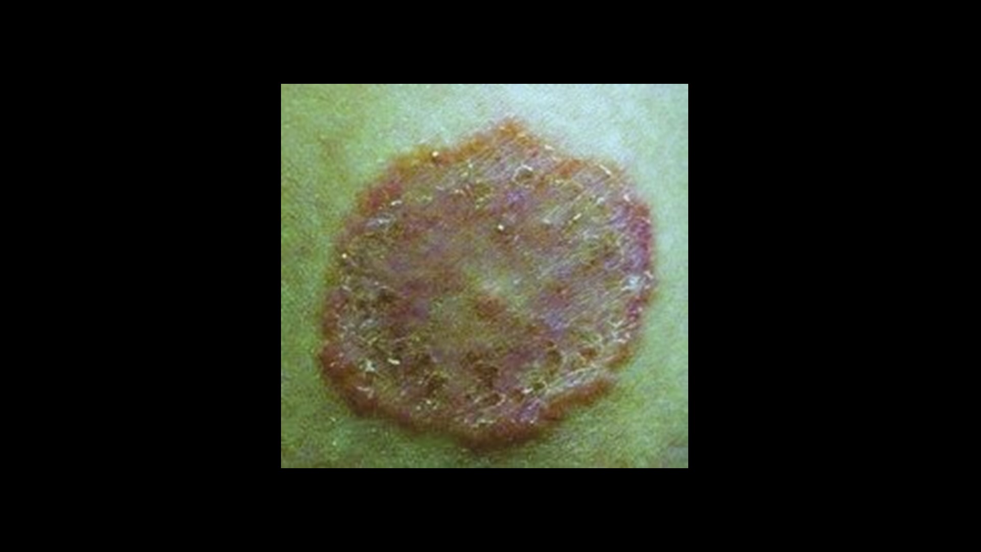 Tinea Corporis Lesion Refractory to Griseofulvin & Miconazole