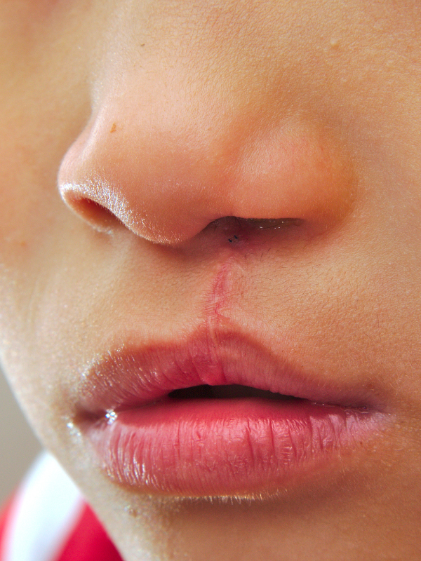 Secondary Corrections in Unilateral Cleft Lip