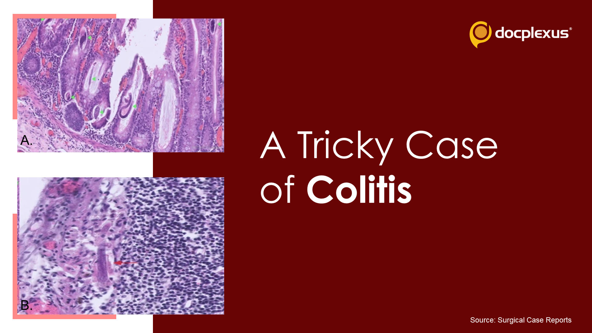 Find the Cause of This Rare Colitis