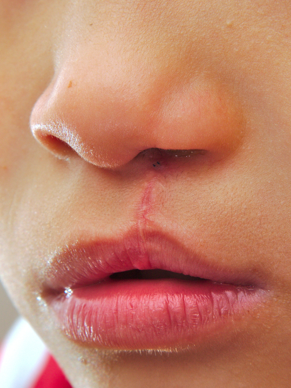 Secondary Corrections in Unilateral Cleft Lip