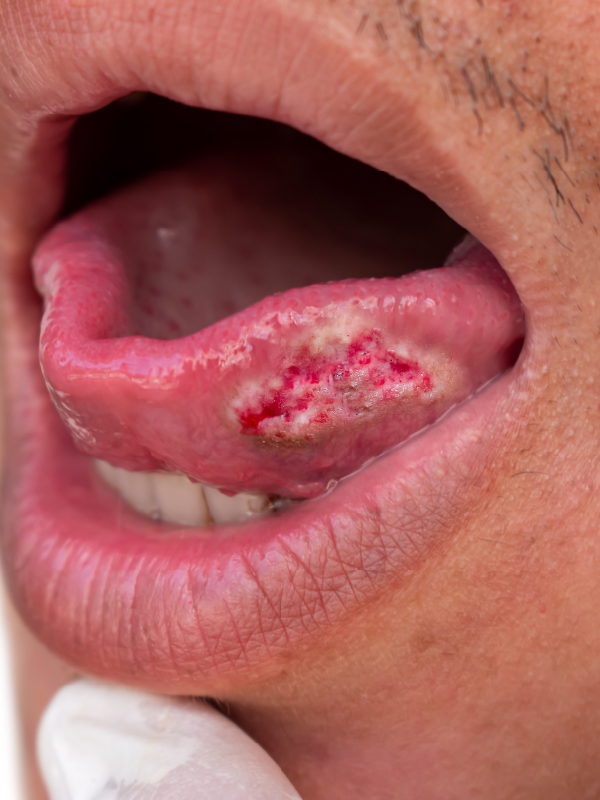 Neoadjuvant Systemic Therapy in Oral Cancer: A Surgeon's Perspective