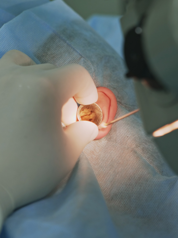 Stapedotomy Ear Surgery to Treat Otosclerosis