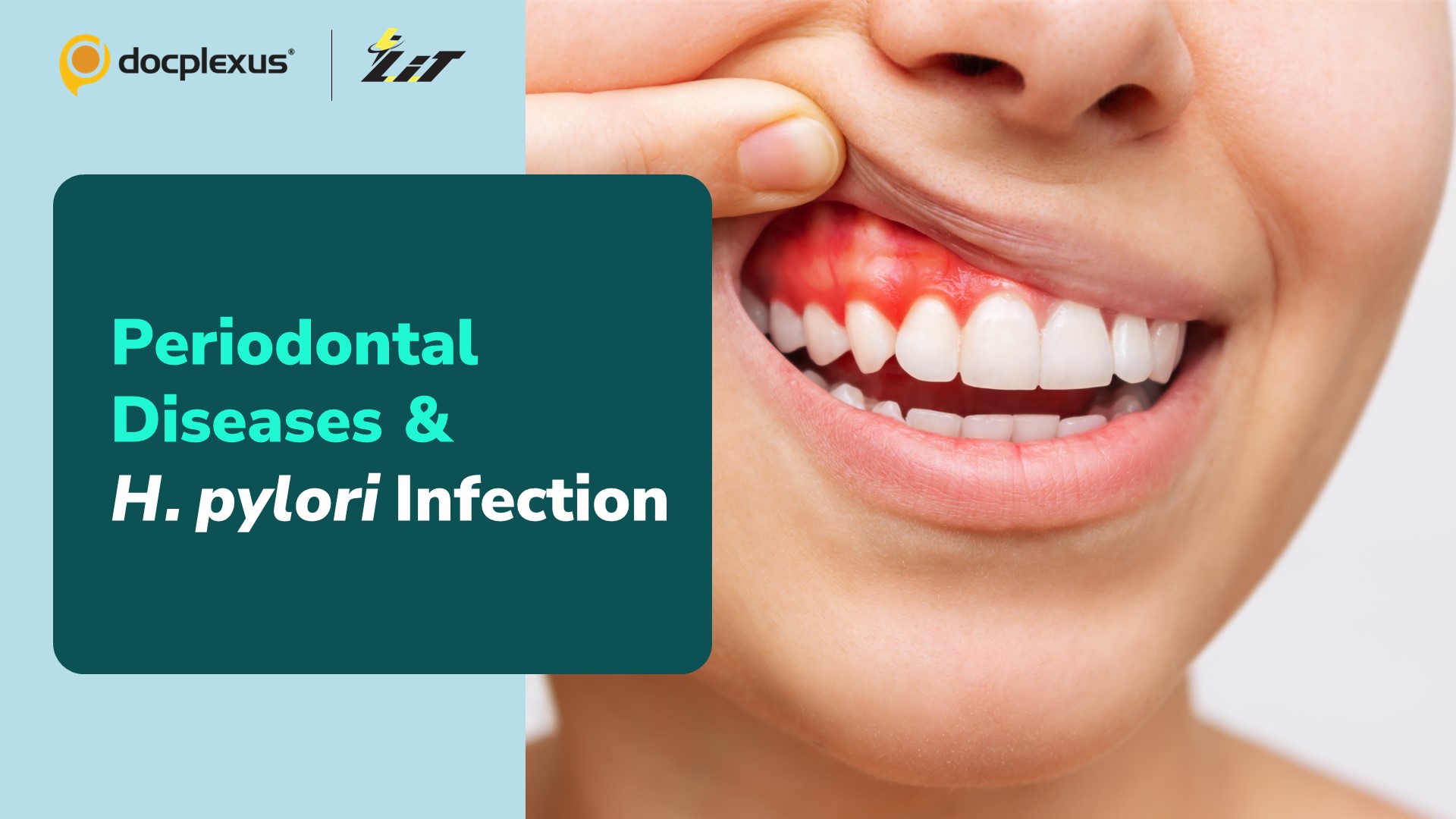 Is There an Association Between Periodontal Diseases & H. pylori Infections?