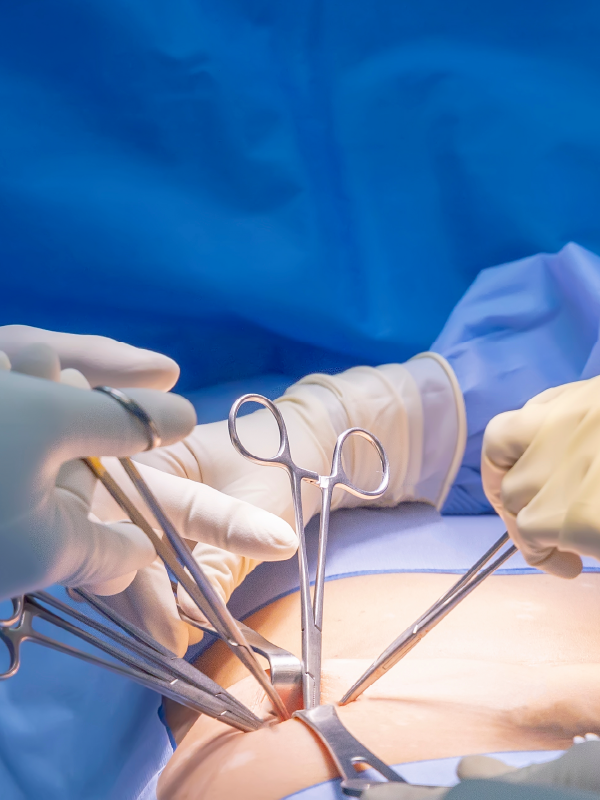 Principles of Surgery for GERD (Lap Hiatus Hernia Repair & Fundoplication)