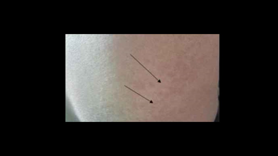 Hypersensitivity Reactions Possible Post Stroke?