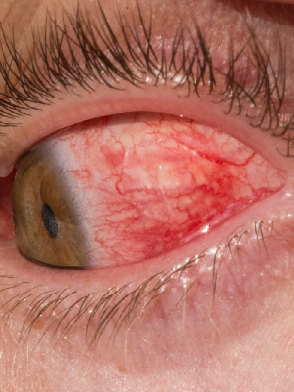 Herpes Simplex Virus Keratitis