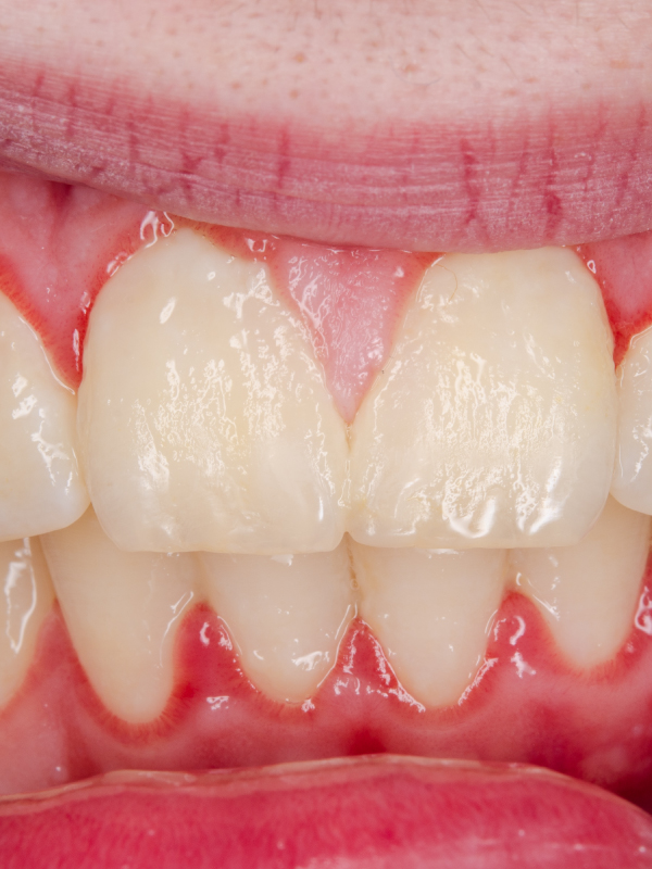 Desquamative Gingivitis