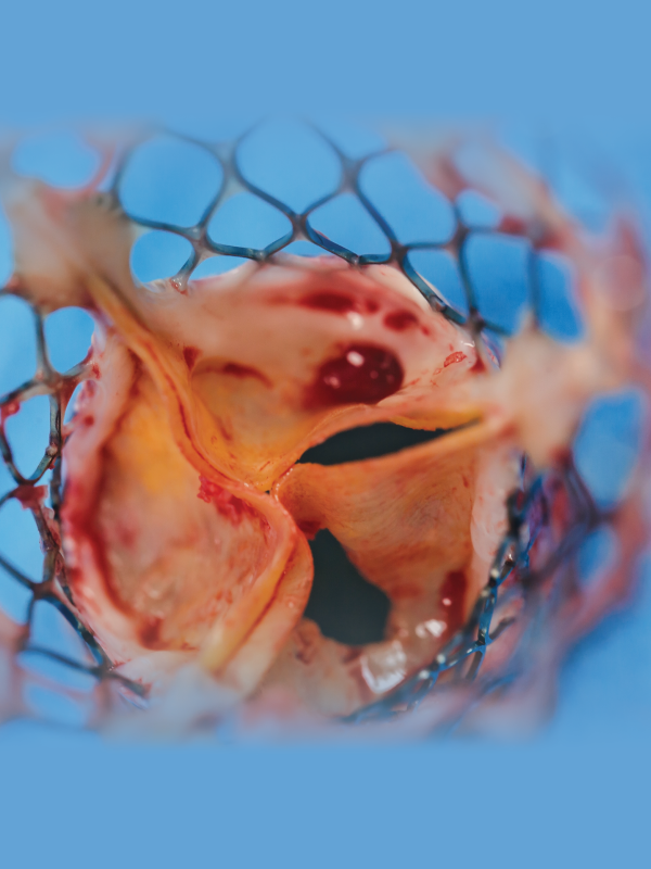 Transcatheter Aortic Valve Replacement