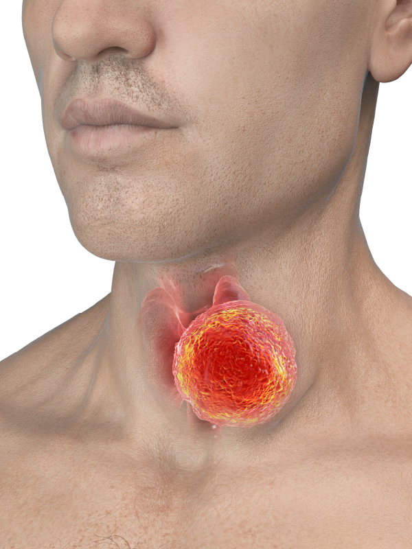 Recent Advancements in Surgical Management of Laryngeal Tumors