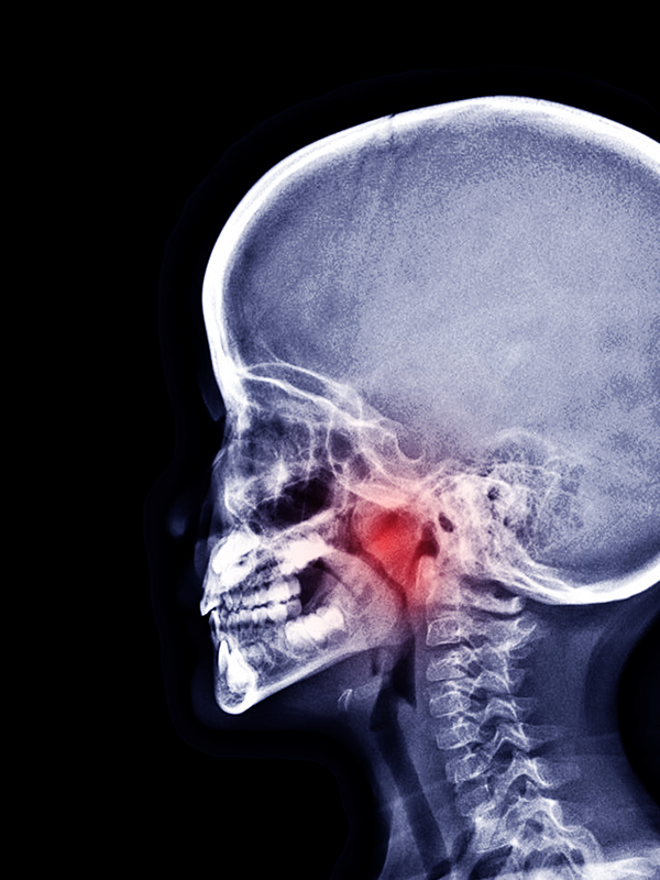 Adenoidectomy