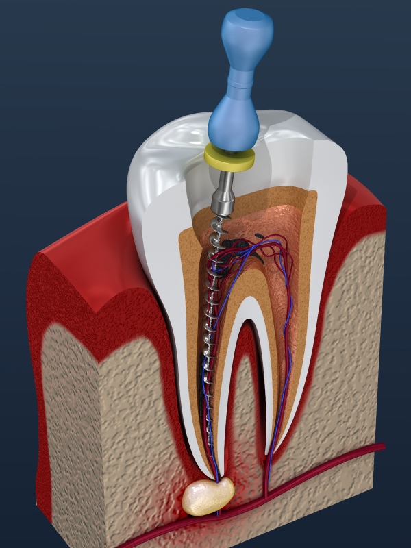 Unlocking the Secrets: Exploring Access Opening in Root Canal Treatment