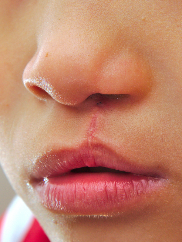 Secondary Corrections in Unilateral Cleft Lip