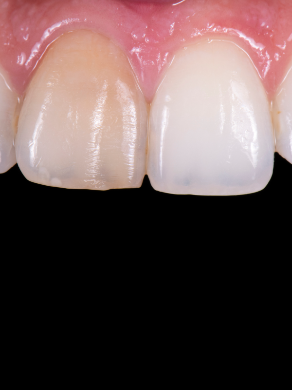 Conservative and Esthetic Treatment Modalities for the Management of Discolored Teeth