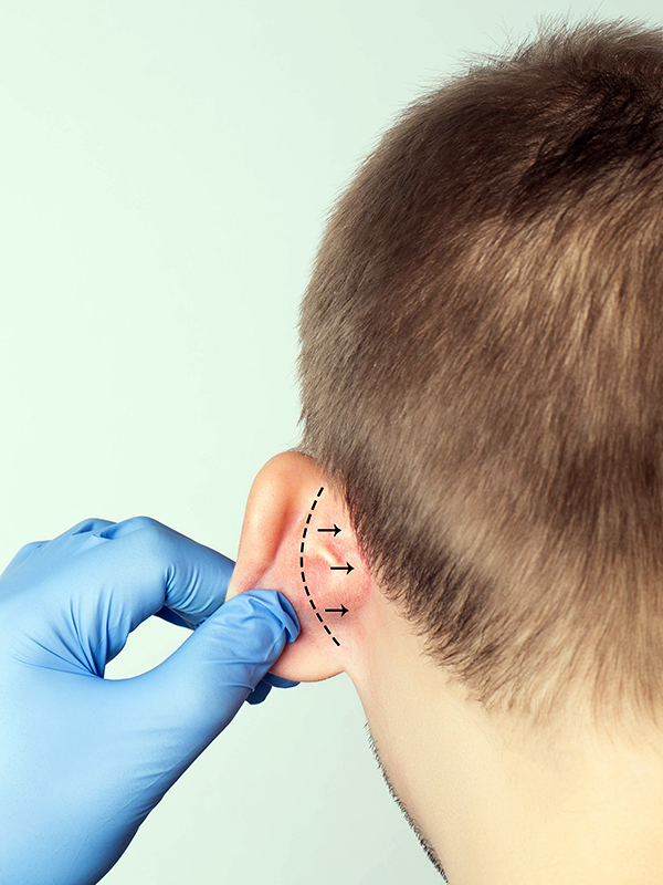 Stapedotomy Ear Surgery to Treat Otosclerosis