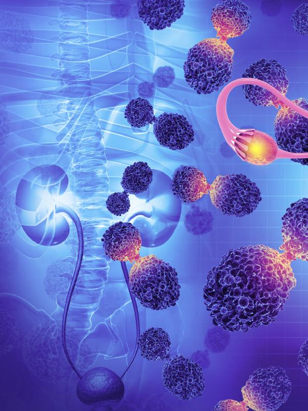Role of Radiation Therapy in Carcinoma of the Cervix