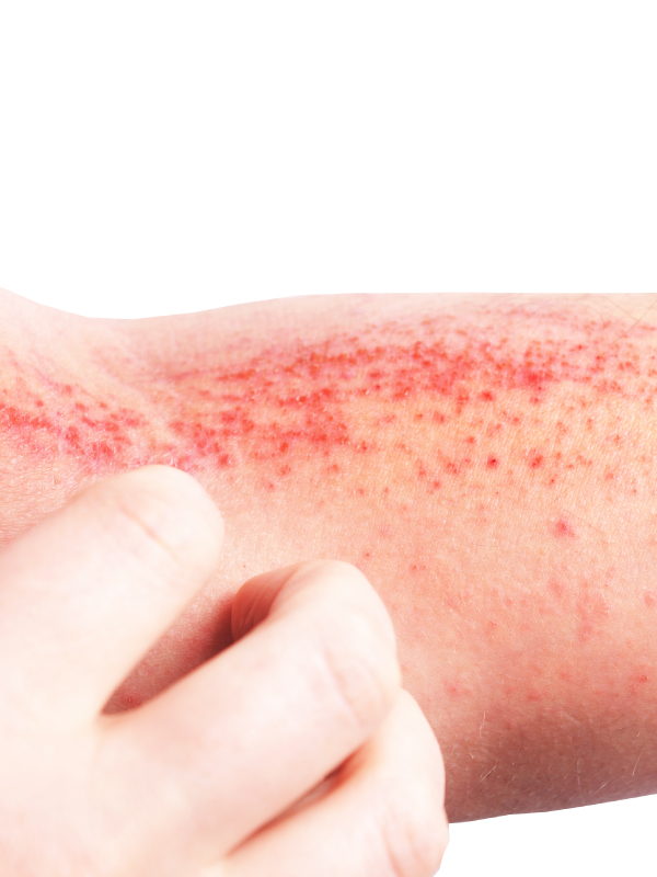 Game Changers in Atopic Dermatitis