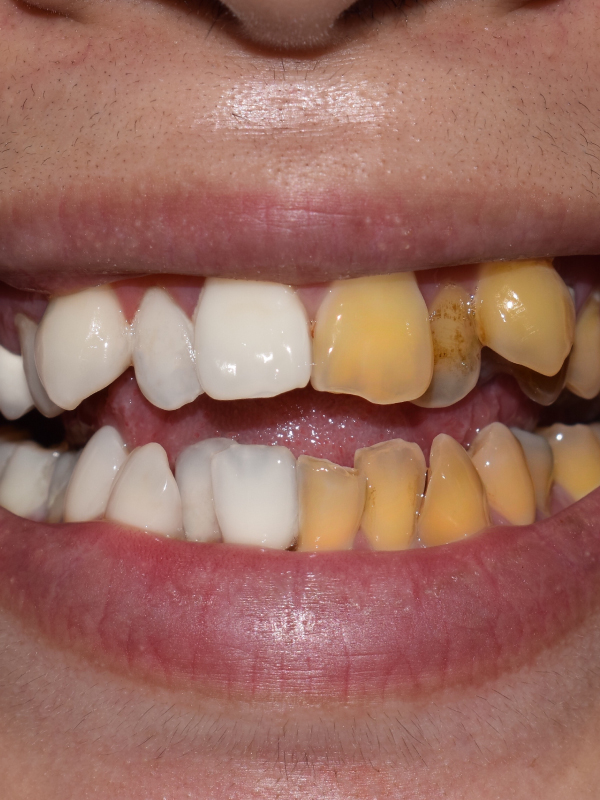 Bleaching Discolored Teeth