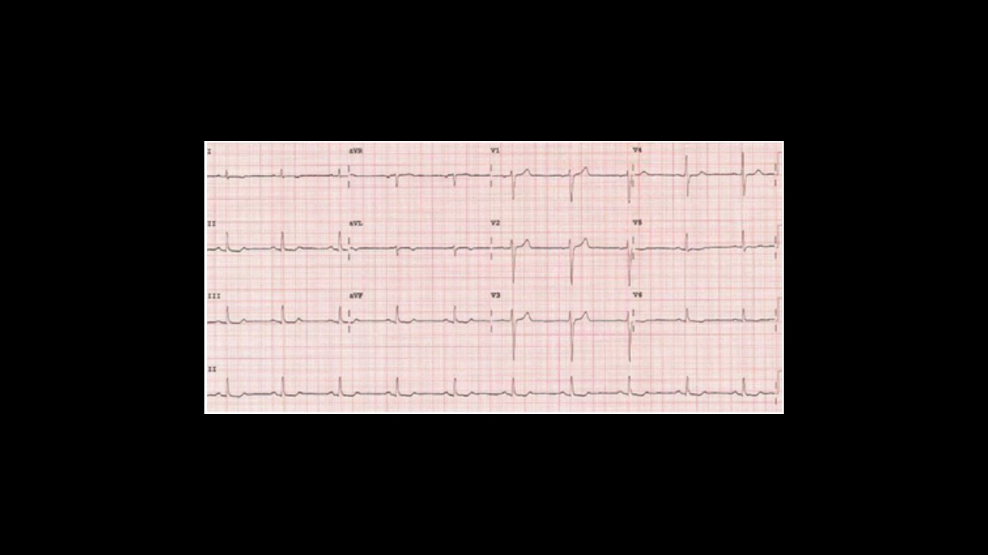 immersion pulmonary oedema - cause/effect?