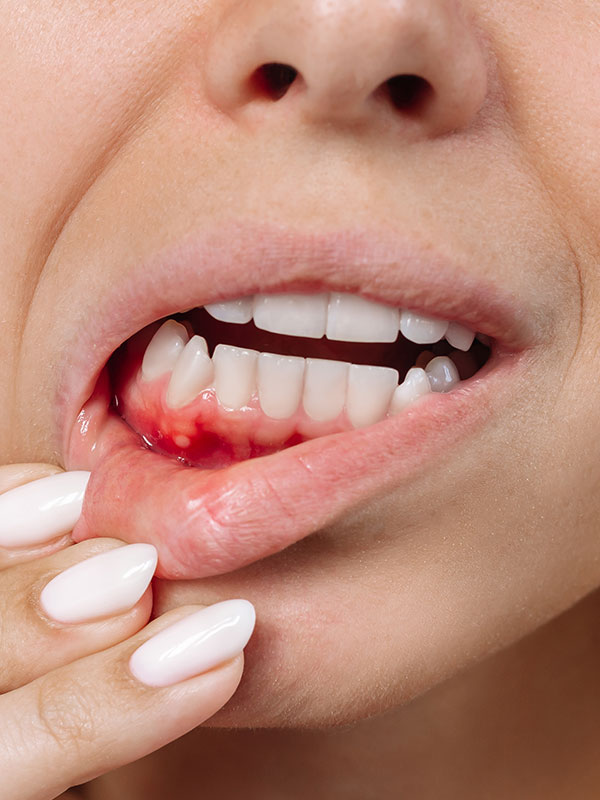 Red & White Lesions – A Diagnostician's Dilemma