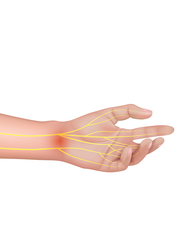 Nerve Entrapment Syndromes