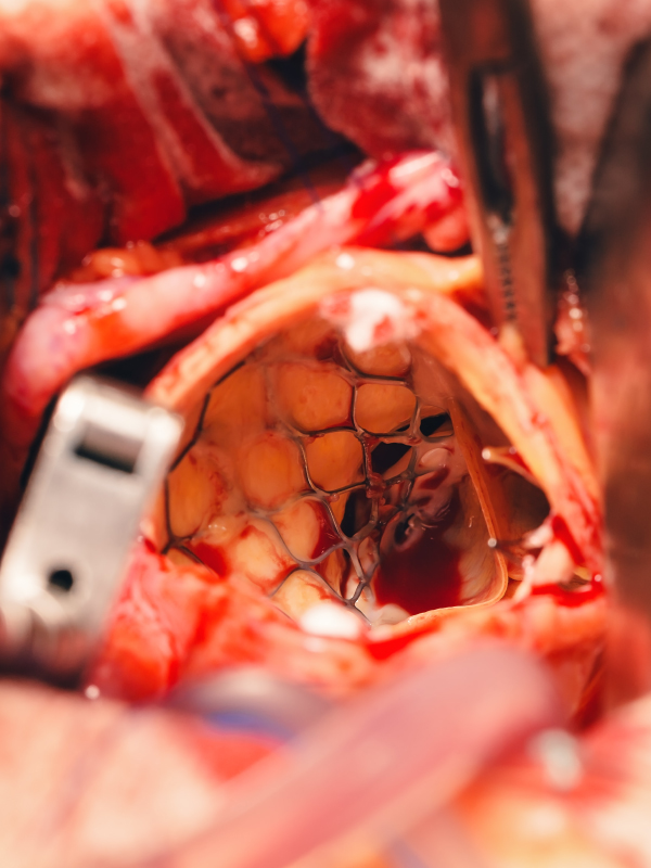 Transcatheter Aortic Valve Replacement