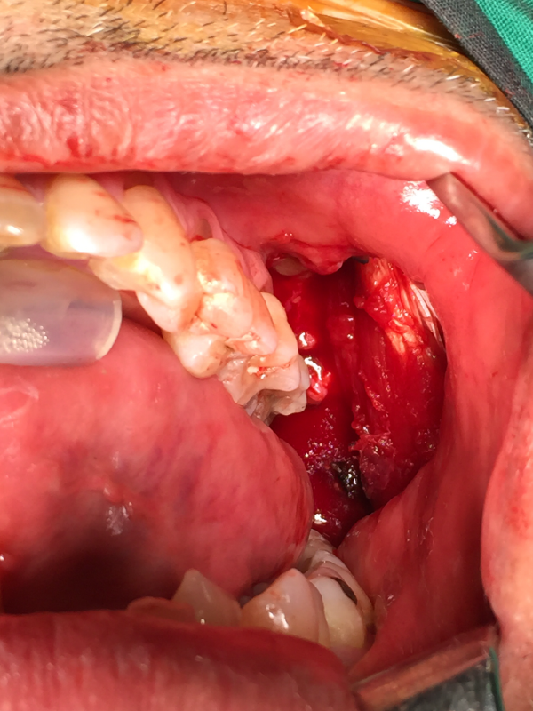 Rehabilitation in Operated Oral Cavity Cancer