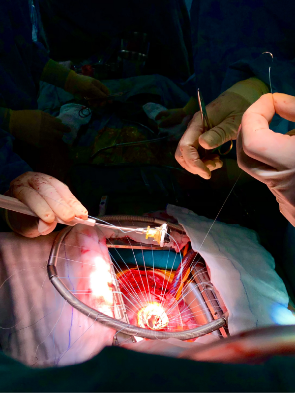 Transcatheter Aortic Valve Replacement
