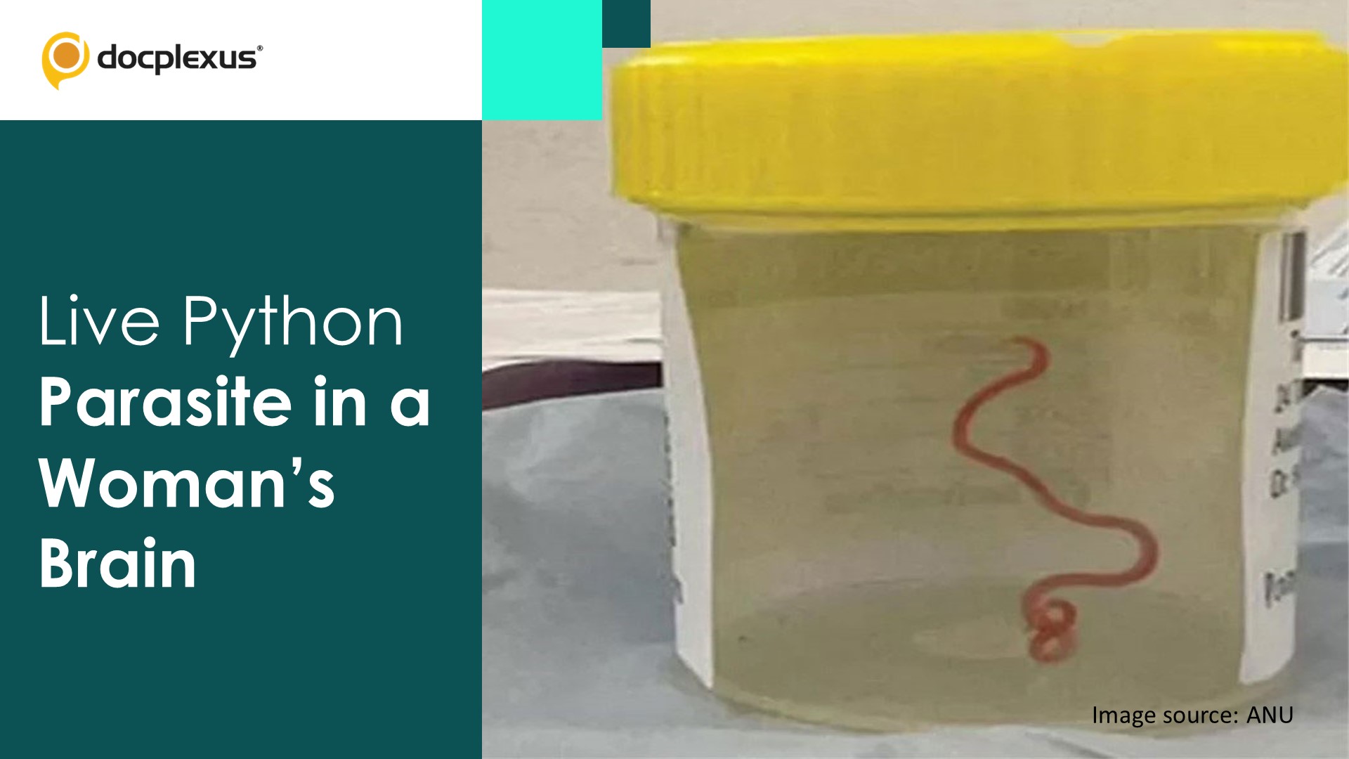World’s First Discovery of a Parasitic Worm in a Woman’s Brain