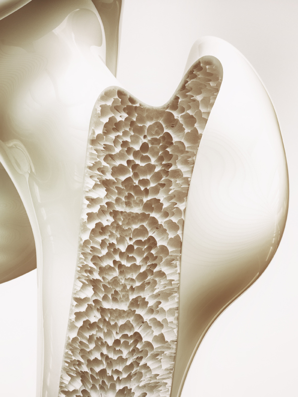 Insights on Osteoporosis