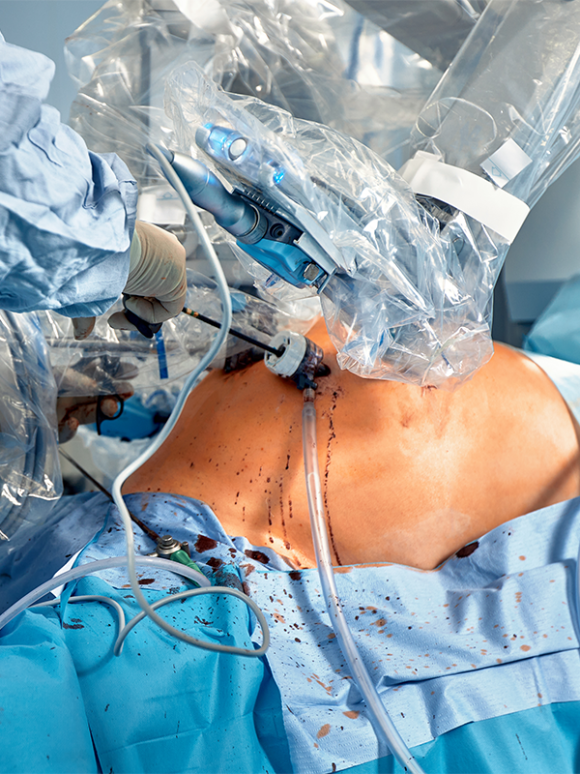 Mini Gastric Bypass Procedure for Obesity & Diabetes