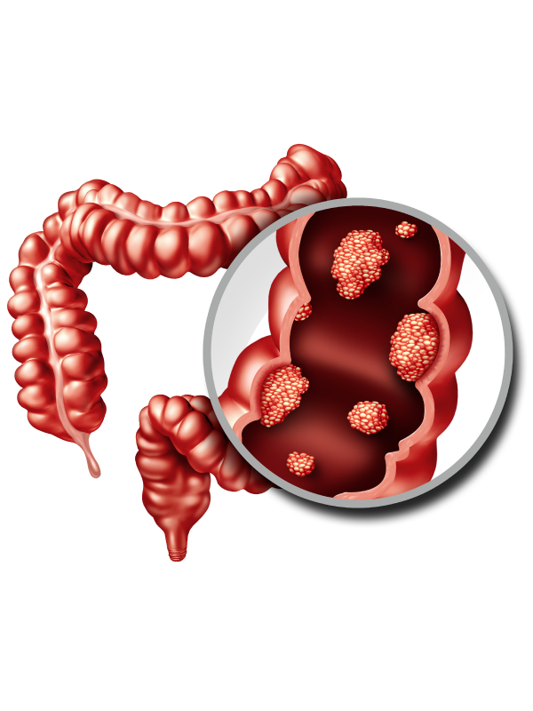 Colonic Polyp and Cancer
