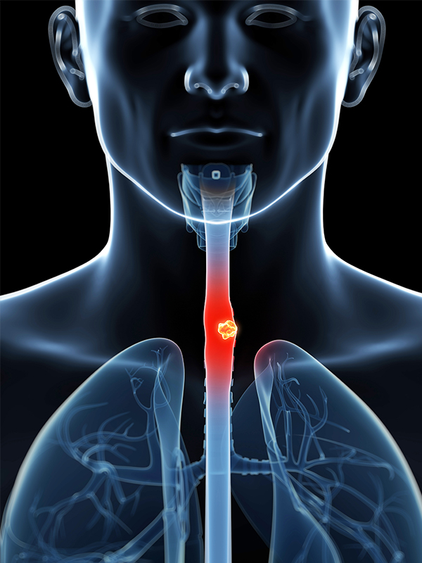 Lateral Decubitus Esophagectomy for Carcinoma Esophagus: Pros and Cons
