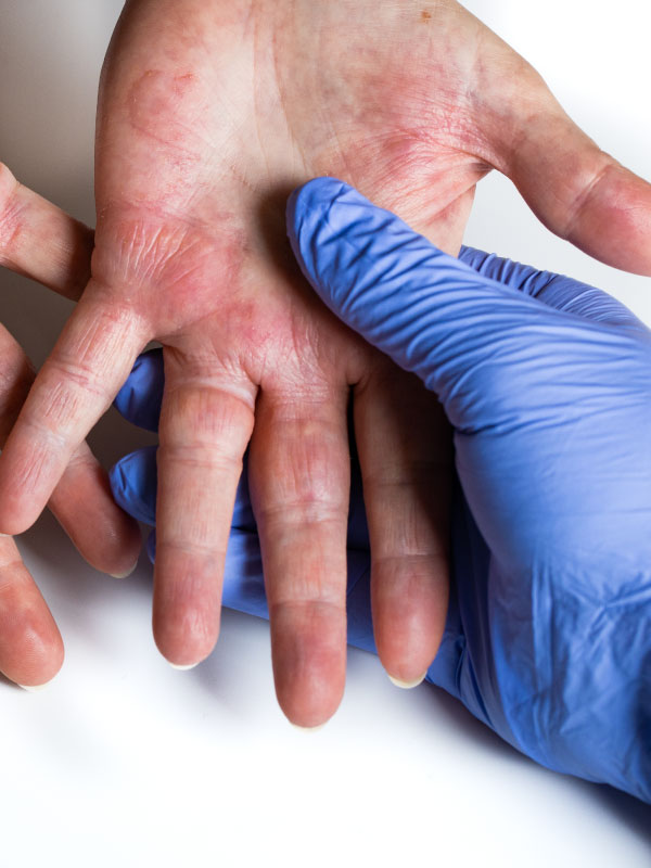 Atopic Dermatitis: Optimizing Outcomes