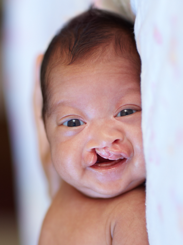 Cleft Palate – Nutrition and Care After Birth