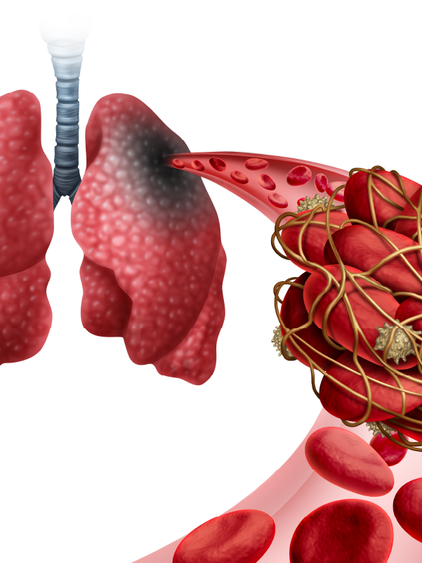 A Case-based Discussion on Pulmonary Embolism and Use of PCSK9 Inhibitors