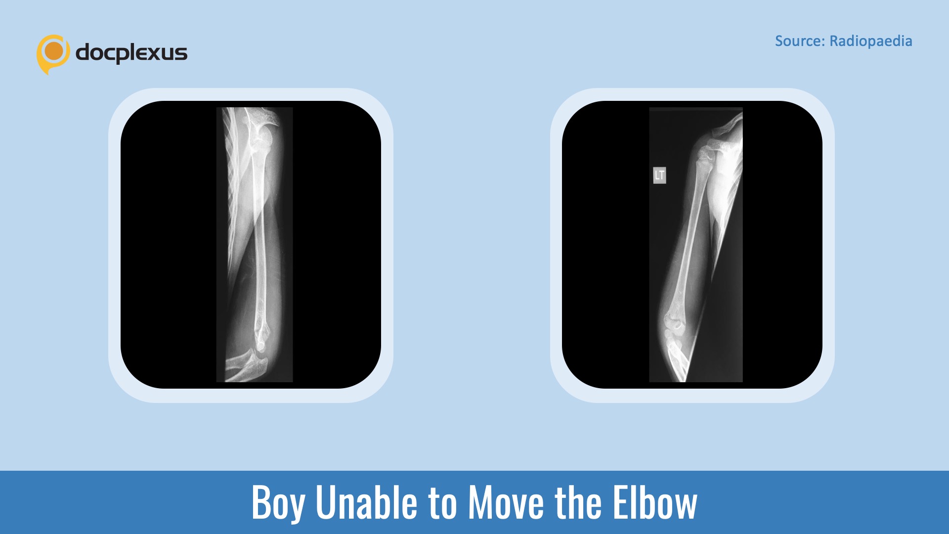 Boy Unable to Move the Elbow