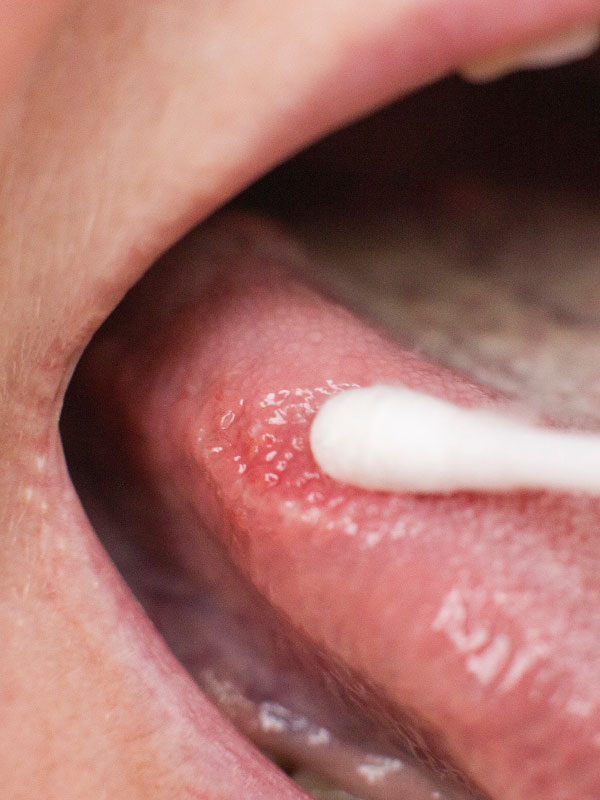 Dealing with Potentially Malignant Lesions of the Oral Cavity