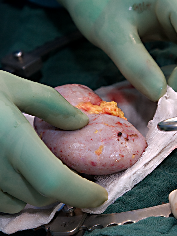 Understanding Basics of Deceased Donor Kidney Transplant
