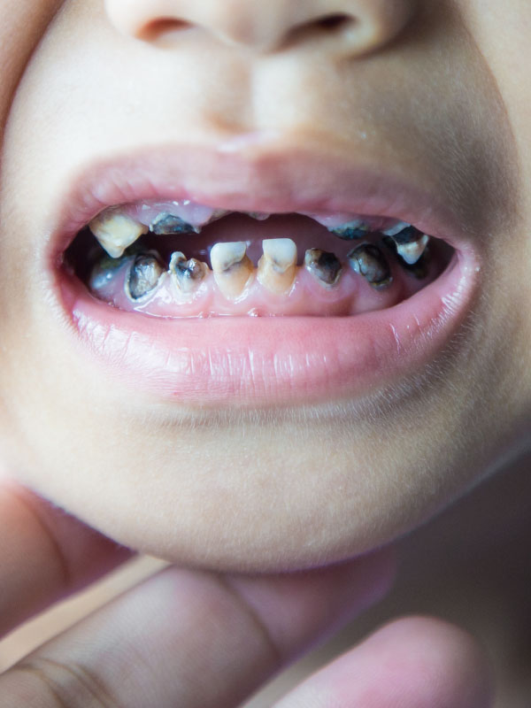 A Bright Future: Strip Crowns in Pediatric Dentistry