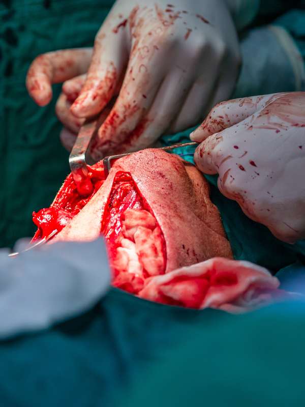 Central Compartment Clearance | Neck Dissection