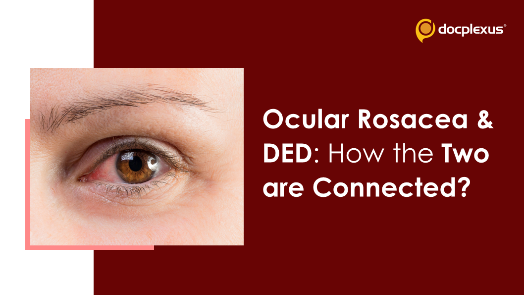 Navigating Through The Challenges Of Dry Eye: Ocular Rosaceae And DED Connection