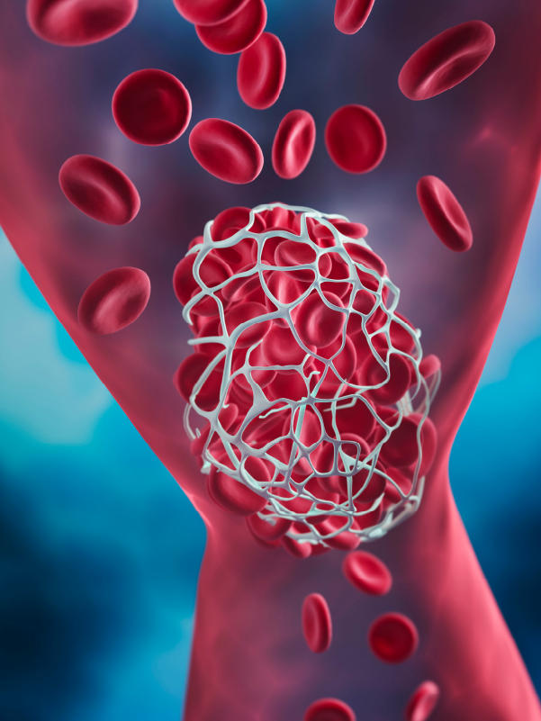 Thrombectomy for Acute Stroke