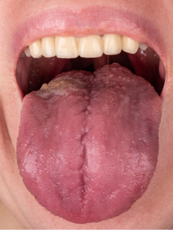 Contemporary Management of Neck in Oral Cancer