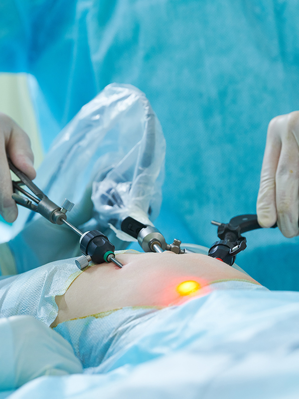 E-TEP Repair of Port Site Hernia