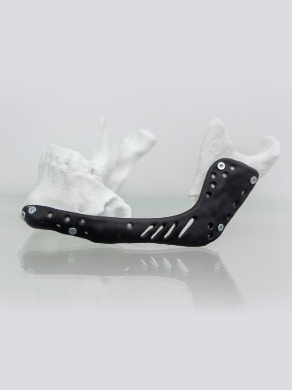Mandibular Reconstruction Using 3D Printing