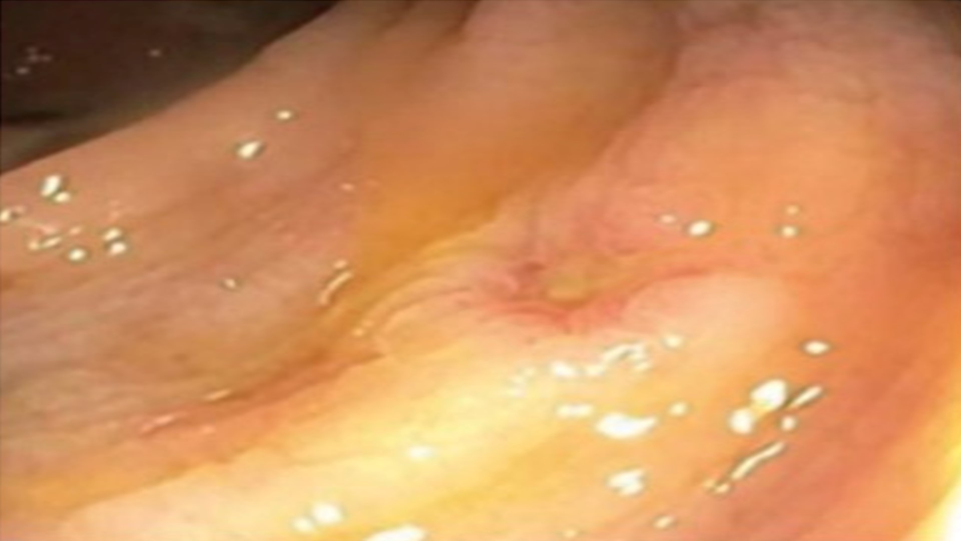 Treating Colitis