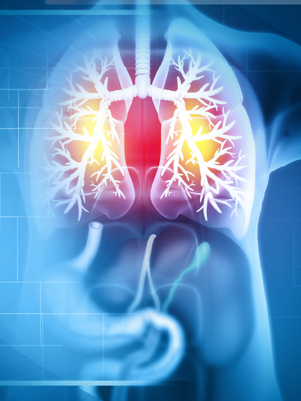 Understanding Interstitial Lung Diseases