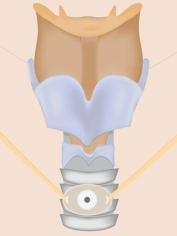 Percutaneous Tracheostomy and Mini Tracheostomy